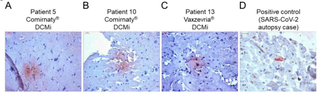 Autopsy Proven Fatal COVID-19 Vaccine-Induced Myocarditis 5