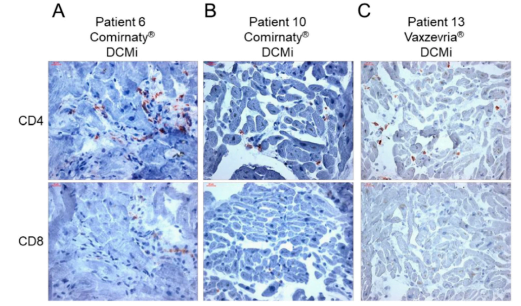 Autopsy Proven Fatal COVID-19 Vaccine-Induced Myocarditis 6